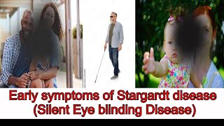 Early Symptoms And Treatment Of Stargardt Disease [upl. by Airuam]