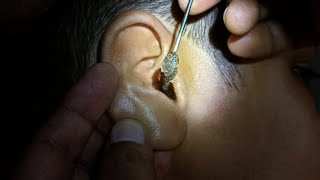 Fully blocked Ear Wax Removal [upl. by Botsford940]