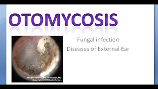 ENT OtoMycosis Fungal Infection Ear [upl. by Nosraep]