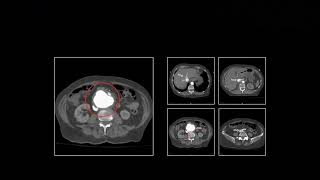 Acute Presentations of Aortic Pathology  Free Radiology CME [upl. by Rusty]