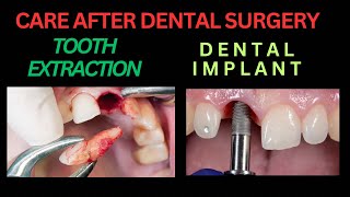 INSTRUCTIONS AFTER DENTAL SURGERY  TOOTH EXTRACTION  DENTAL IMPLANT  PRECAUTIONS OF ORAL SURGERY [upl. by Anastase]