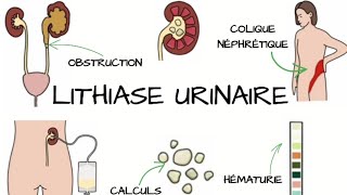 LITHIASE URINAIRE Signes et Symptômes diagnostic traitement  Complications [upl. by Tilford]