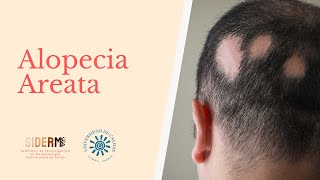 Revisión Alopecia Areata [upl. by Ahsirek]