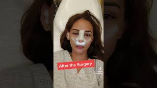 The day before rhinoplasty in the Philippines rhinoplasty philippines fypシ [upl. by Sivat260]