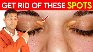 Get Rid Of These Spots  Fat Under Eyes  Xanthelasma  Natural Remedies  Dr Vivek Joshi [upl. by Nerissa362]