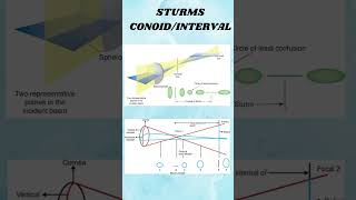 Astigmatism shortvideio viralshort ytshorts [upl. by Larry135]