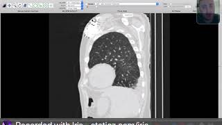 Radiological cases  Chest  CT signs of fissural entrapped pleural effusion [upl. by Marnia]