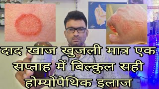 Best Homeopathic medicine for allergyRingworm eczema skin disease [upl. by Meid283]