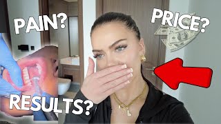 I got veneers in Dubai no teeth shaving before  after VLOG [upl. by Kobylak]