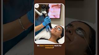 Do Laser Treatments Work for Melasma [upl. by Imhskal]