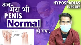 Successful Hypospadias Surgeon in Kolkata  मूत्र का छिद्र सही जगह पर न खुलने की समस्या  Dr Nagwani [upl. by Ettenirt]