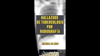 Tuberculosis en Radiografía Diagnóstico y Manifestaciones Clave [upl. by Rafiq742]