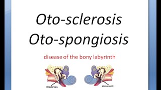 ENT Otosclerosis Part 1 OtoSpongiosis Autosomal Dominant carhart osteogenesis imperfecta Schwartze [upl. by Errol]