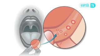 Aft Ağız Yarası Nedir [upl. by Sigler385]