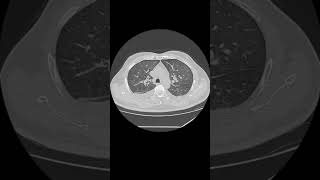 Bilateral pleural effusion [upl. by Eugene694]