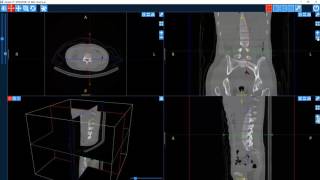 Surgimap Desktop Software Pedicle Screw Planning [upl. by Vyner568]