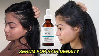 I tried The Ordinary Serum for Hair Density for 4 months amp THIS HAPPENED  Before and after results [upl. by Noble]