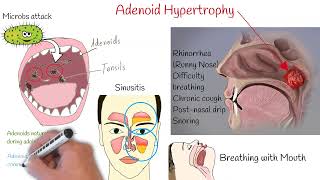 Adenoid Hypertrophy  If your kid sleeps with open mouth you should watch this video [upl. by Ydnat]