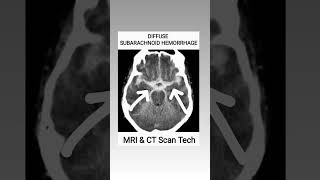 Subarachnoid Hemorrhage CT Scan viral youtubeshorts ct shortsfeed [upl. by Massimiliano]