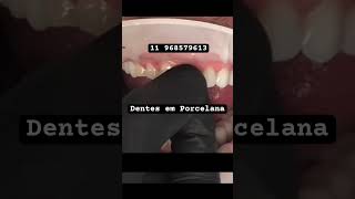 Dentes em Porcelana [upl. by Delcine]