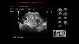 oncocitomi multipli ai reni [upl. by Lleder]