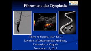 SIRRFS Webinar 111913 Fibromuscular Dysplasia [upl. by Nhor]