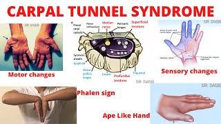 Carpal Tunnel Syndrome CTS [upl. by Iatnahs]