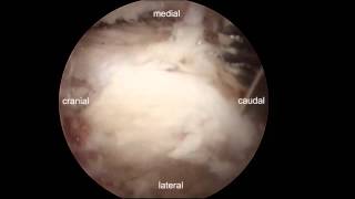 Endoscopic decompression for lumbar stenosis by UBE [upl. by Annahc894]