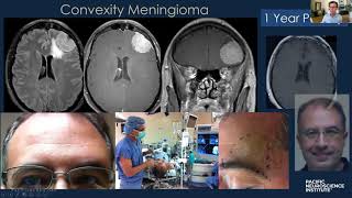 Keyhole Meningioma Removal with Dr Daniel Kelly [upl. by Goff]