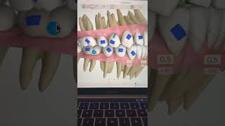 TIP 79  CANTEO OCLUSAL SIN MICROTORNILLOS [upl. by Dhu]