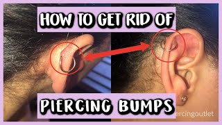 HOW TO GET RID OF PIERCING BUMPS [upl. by Llerad7]