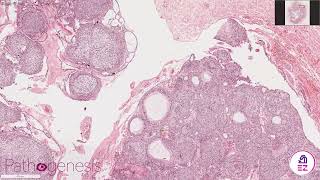 Adenomatoid Odontogenic Tumour AOT [upl. by Artima]