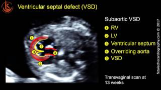 Fetal echocardiography at 1113 weeks Ventricular Septal Defect VSD [upl. by Ailasor125]