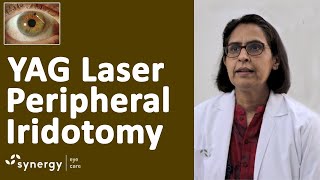 Laser Iridotomy for Glaucoma  Yag Laser Pi Peripheral Iridotomy [upl. by Anerahs]