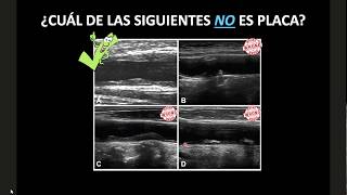 DOPPLER CAROTIDEO  PARTE II [upl. by Cynthia]