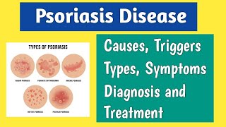 Psoriasis Causes Triggers Types Symptoms and Treatment  How To Cure Psoriasis [upl. by Amarillis]