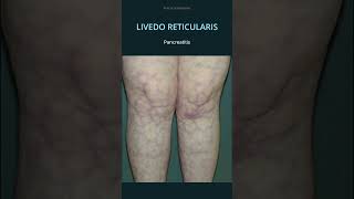 Livedo Reticularis Causes osce practicalmedicine diagnosis sle [upl. by Mure]