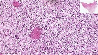 Osteomyelitis  Histopathology [upl. by Peg311]