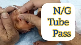 Nasogastric NG Tube insertion in neonateNewborn  How to place a nesogastric  NG feeding tube [upl. by Euqirrne]