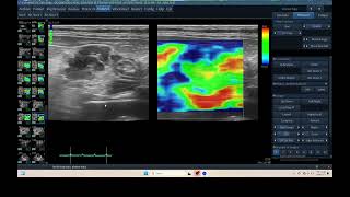 IQ 304 MESENTARY LYMPHOID NODE ENLARGEMENT ULTRASOUND ECHOPAC ANALYSIS ELASTOGRAPHY pancreatitis [upl. by Sheelagh945]