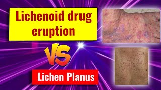 Lichenoid drug eruption features and comparison with lichen planus [upl. by Khajeh424]