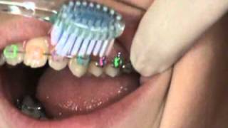 How to brush with braces  Dr Powells office demonstrates [upl. by Vedette]