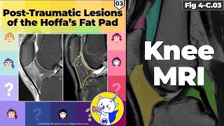 Fig 4C03 Posttraumatic Lesions of Hoffa’s Fat Pad [upl. by Cally18]