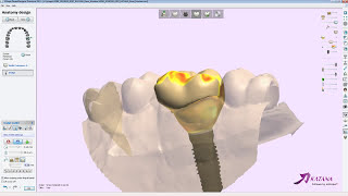 Digital Design Workflow of Screw Retained Crown in 3Shape Part 2 [upl. by Akilaz]