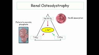 12DaysinMarch Renal Osteodystrophy for the USMLE Step One [upl. by Trisha]