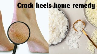 Crack Heels Home Remedy By Using Vaseline  Glycerin For Heels  Heels Treatment With Candel [upl. by Puna]