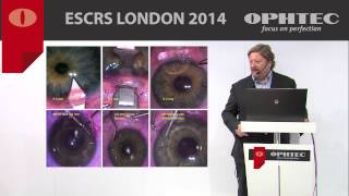 Zero astigmatism outcomes in Phakic IOL implantation by Prof M Pozharitsky Russia [upl. by Semela]