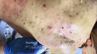 blackhead removal blackheads removal blackhead blackheads blackheads lips blackheads around lip [upl. by Thorin]