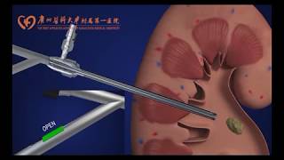 Super‐mini percutaneous nephrolithotomy [upl. by Photina]