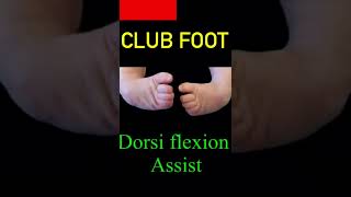 Club Foot CTEV K  Tape correction  5 Days Old Baby shorts by Dr Girish physiotherapist [upl. by Hellman364]